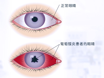 葡萄膜炎与正常人的眼睛有什么不同